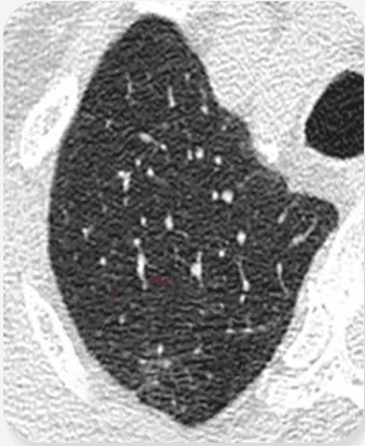 High-Dose Scan