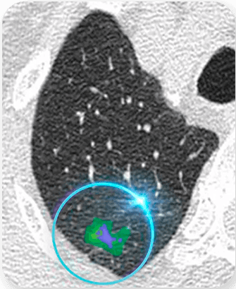 Ai-Enhanced Ultra Low-Dose Scan