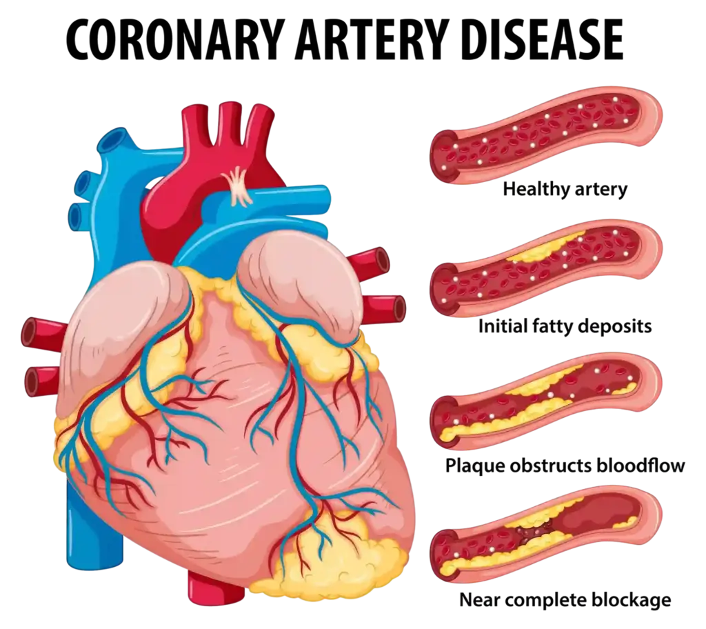 Image of coronary artery disease