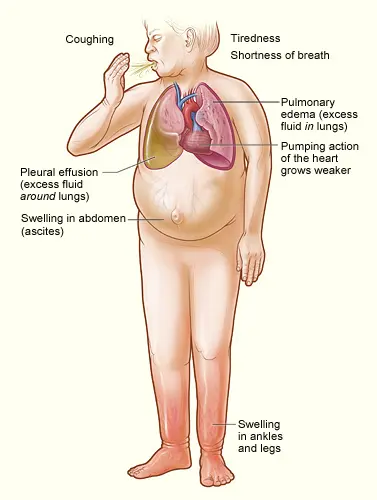 Early symptoms of CHF