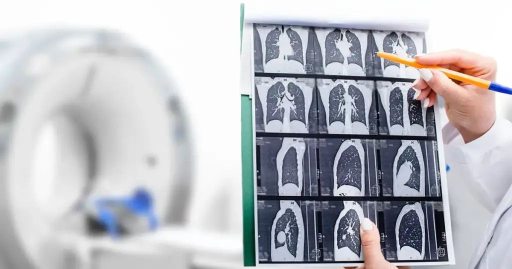 The Role of Ai in Lung Cancer Screening
