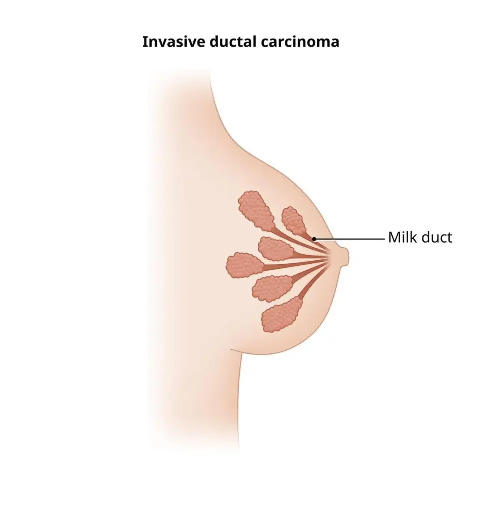 Invasive Ductal Carcinoma
