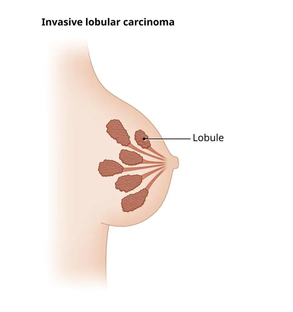 Invasive Lobular Carcinoma
